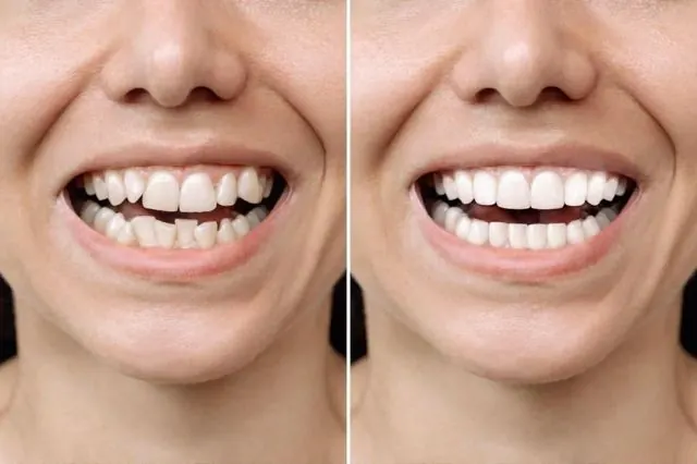 Cosmetic dentistry smile makeover