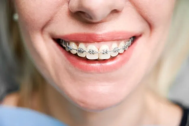 Dental braces by an orthodontist in Vasanth Nagar
