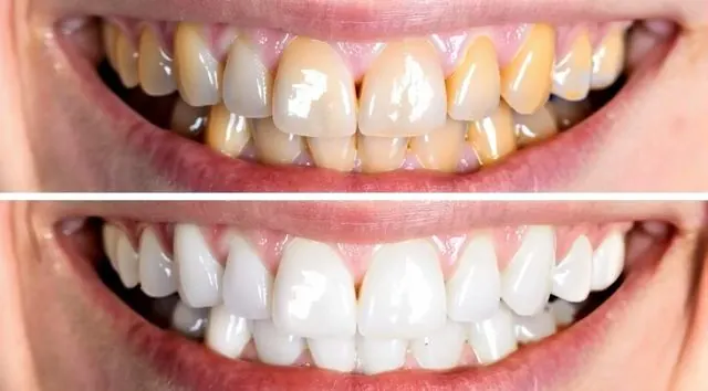 Teeth cleaning and whitening before and after