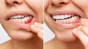 Gum treatment before and after
