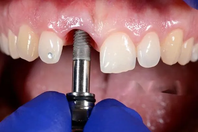 Dental implant and dentures in Bangalore