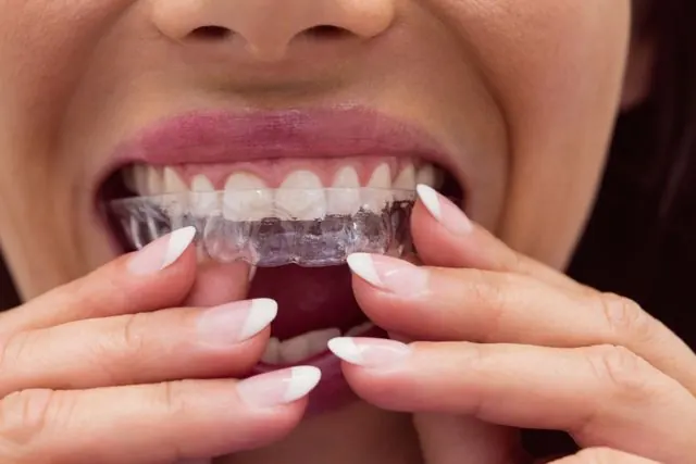 Invisible aligners and braces at Beyond Dental