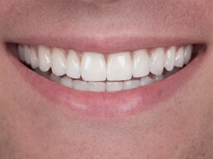 Smile makeover - after treatment