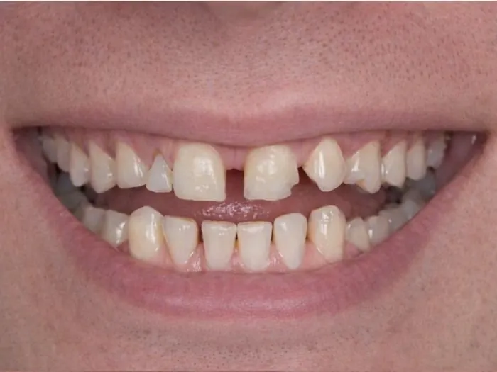Smile makeover - before treatment
