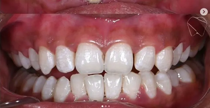 Restorative dental treatment - after treatment