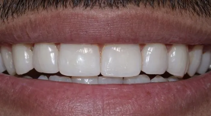 Clear aligner treatment - after treatment