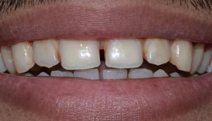 Clear aligner treatment - before treatment