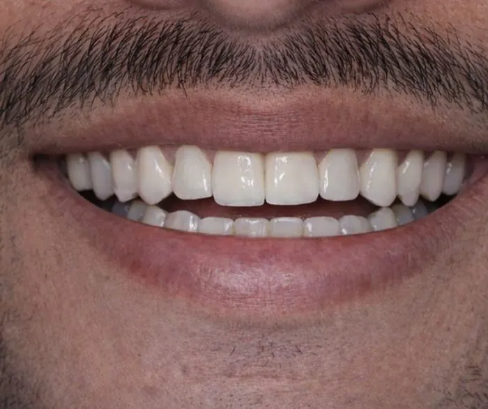 Cosmetic dental treatment - after treatment