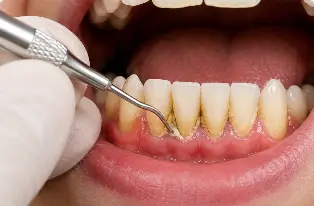 Tartar removal treatment in Vasanth Nagar